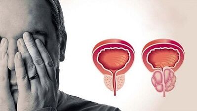Erkeklerde prostatit gelişiminin nedenleri