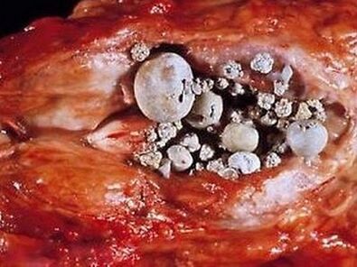 Taşlı prostatit ile prostat bezindeki taşlar